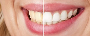 Teeth Whitening