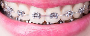 Braces